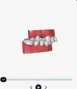 Byte Aligners Review: Legit or Scam?