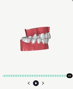 Byte Aligners Review: Legit or Scam?